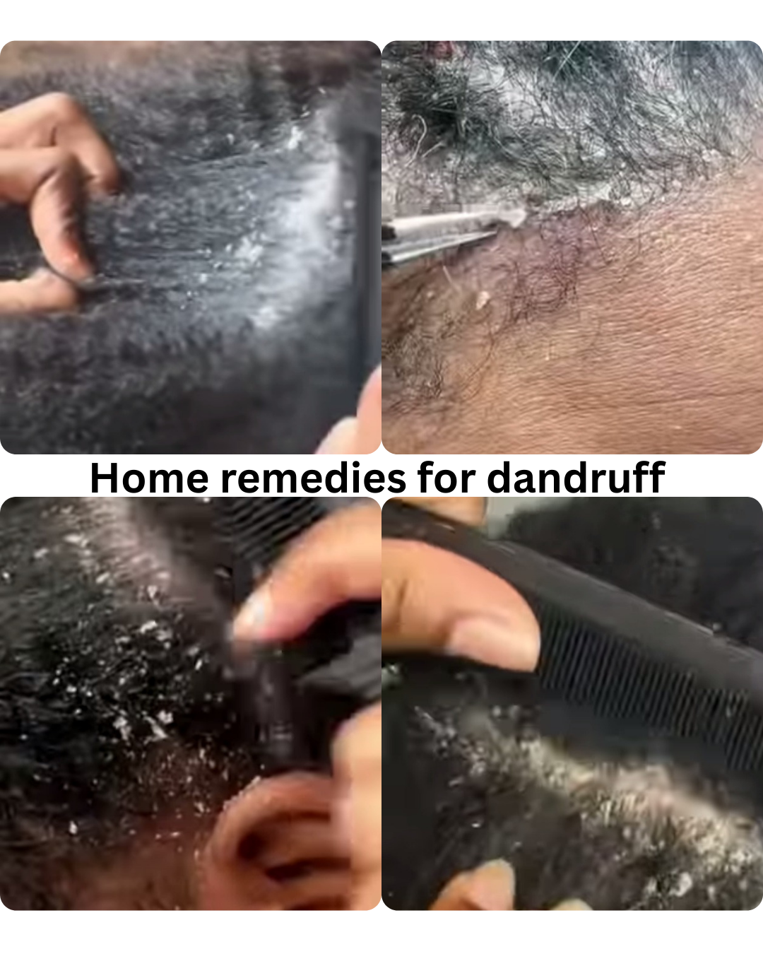 Home-remedies-for-dandruff