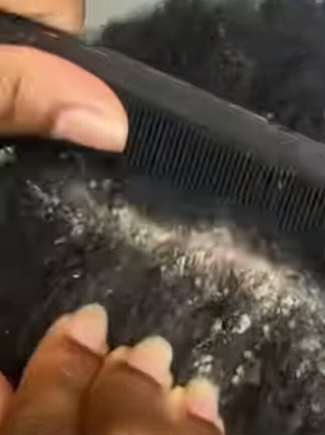 remedy-for-dandruff