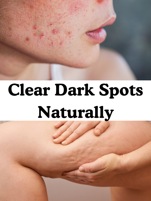 how-to-remove-dark-spot-on-the-body-naturally
