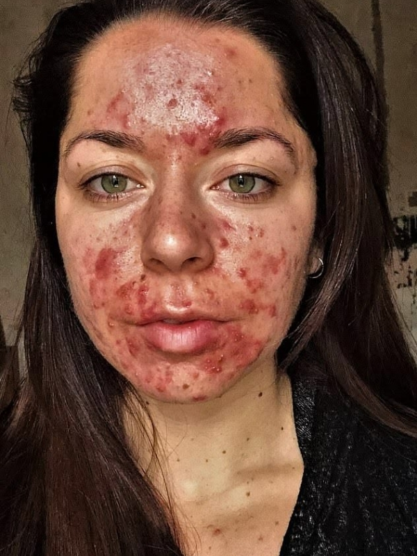 What-causes-facial-spots 