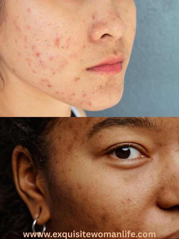 how-to-remove-dark-spots-on-th-face-fast-and-naturally